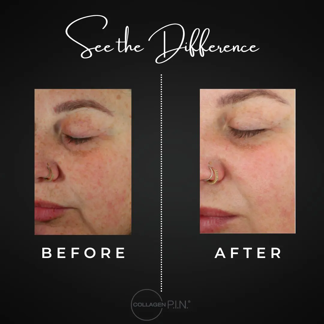 Collagen P.I.N before and after pictures of a womans face